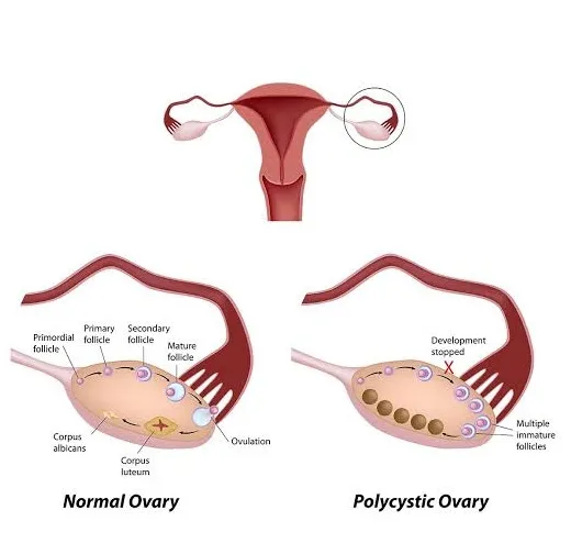 pcos and pregnancy