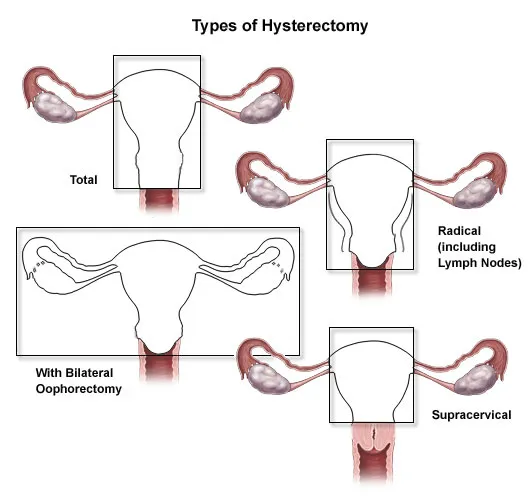 Type Hysterectomy